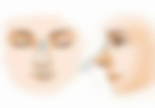 自体肋骨隆鼻究竟好不好？优势显著，自然持久塑形，适配面部轮廓还减少创伤 