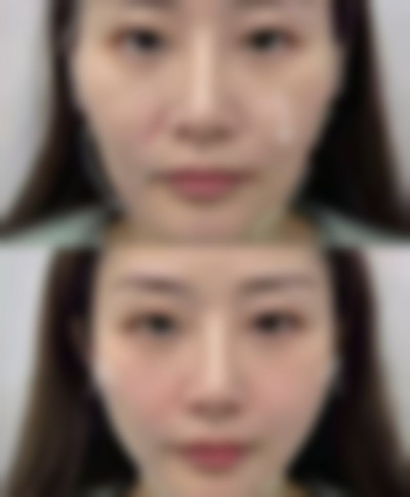 有眼袋黑眼圈困扰怎么办？医美治疗来助力