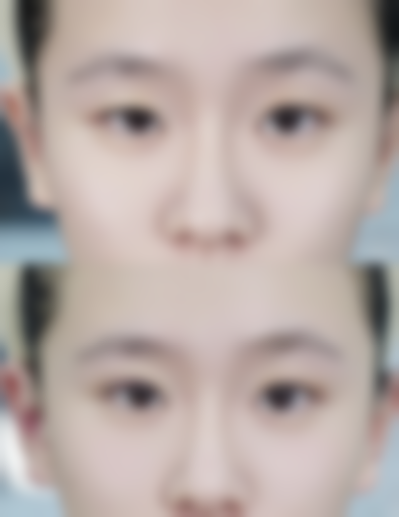 小孩脸被指甲抓伤留疤咋消除？物理与手术治疗显神通