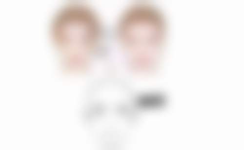 全切双眼皮联合眼袋手术消肿后的优势