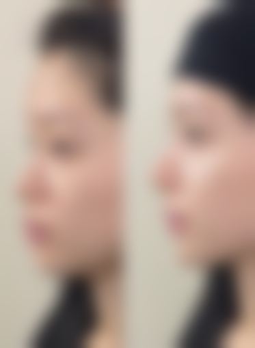 哪些因素会影响抽脂风险发生？