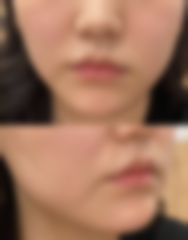 抽脂有哪些危及生命的具体风险？