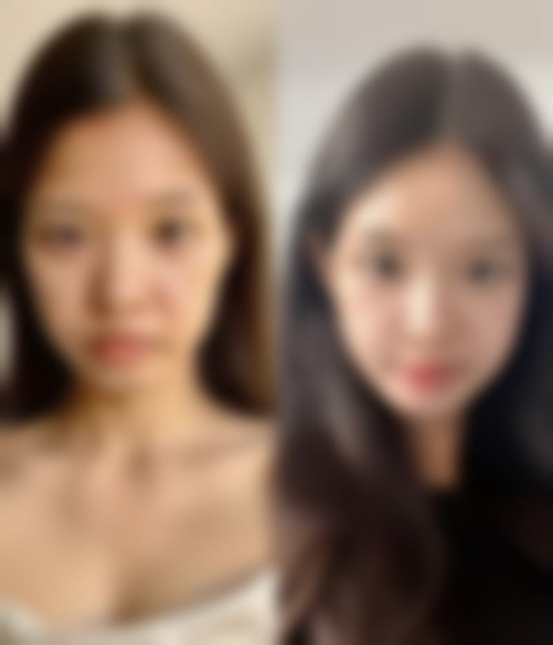 手背上烫伤疤痕怎么去除？个性化方案+日常护理，多管齐下淡化疤痕！ 