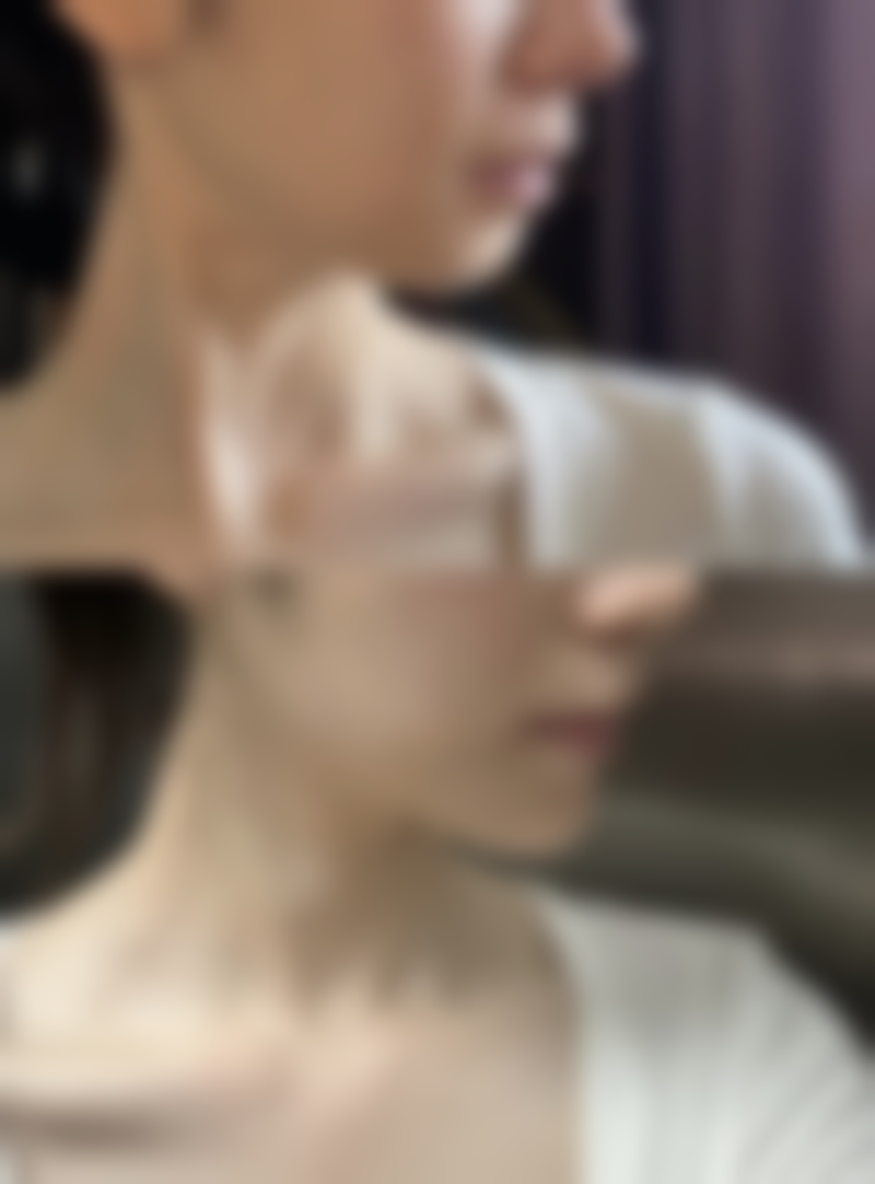 日常护理助力疤痕增生黑色素沉淀快速消退