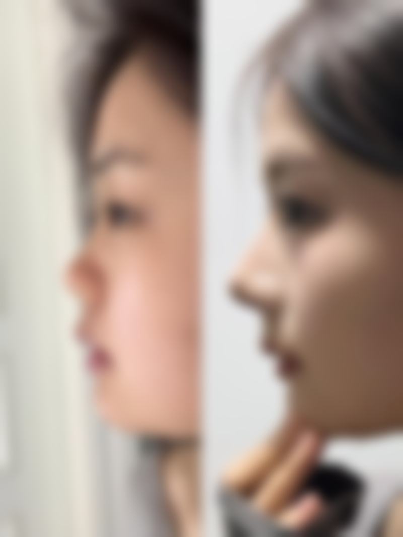 疤痕增生黑色素沉淀多久能消？受多因素影响，积极干预或 1 个月快速淡化 