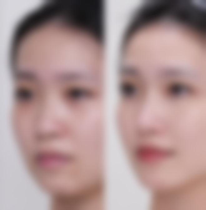 缝针疤痕修复期间这样护理