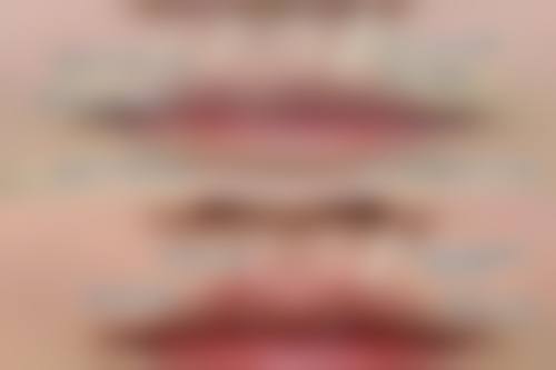 曼托假体隆胸究竟好不好？耐用性强，寿命长久