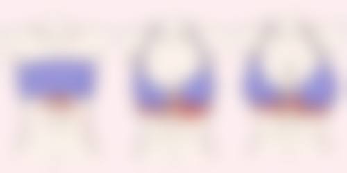 曼托假体隆胸究竟好不好？适配人群广泛，总有一款适合你