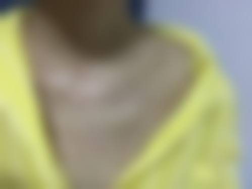 五、聊城市东昌府人民医院烧伤整形外科实例