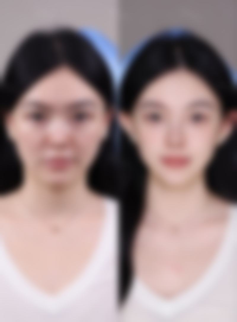 手臂抽脂何时能修复如初？影响修复的因素大揭秘