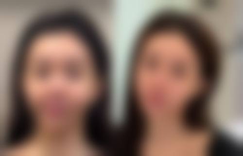 打瘦脸针术后护理要点