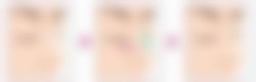 打瘦脸针特殊修复情况说明