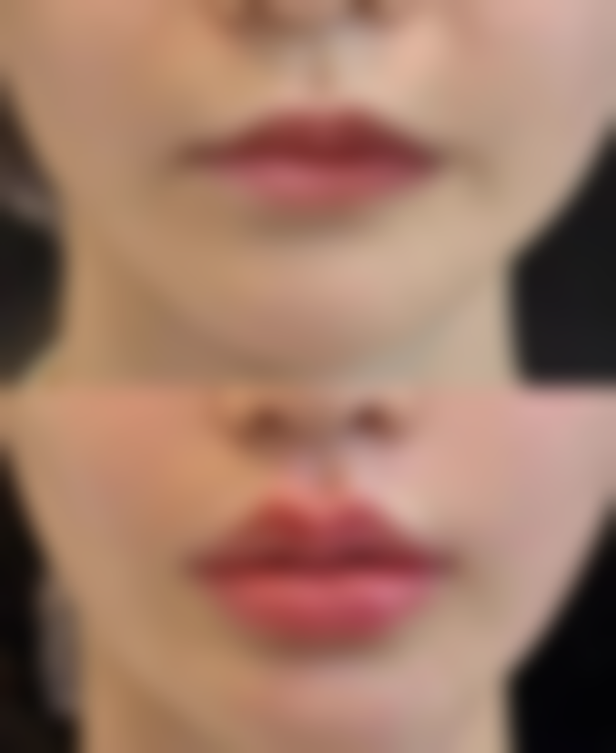 耳软骨隆鼻潜在短板之支撑力不足