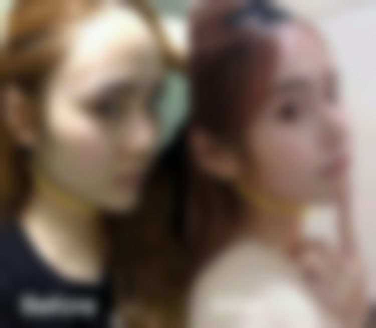 杭州连天美医疗美容医院皮秒激光祛斑平扫模式——医院优势超突出