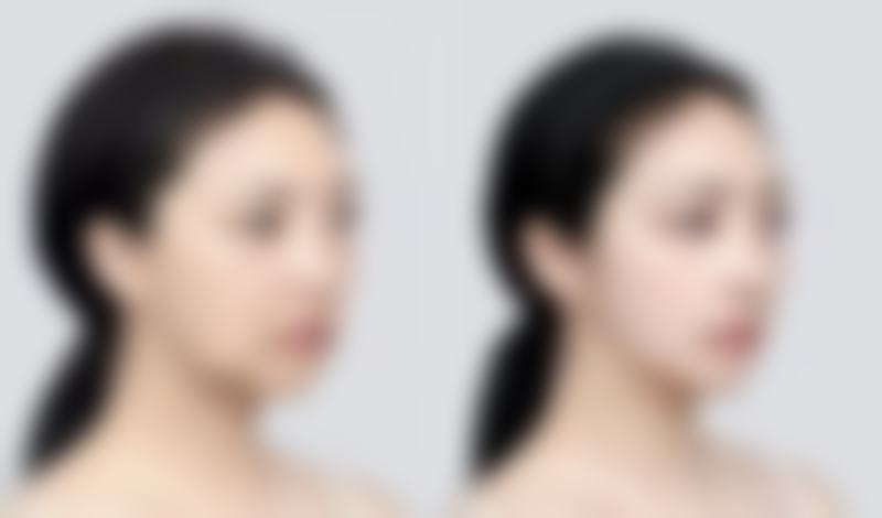 额头摔伤缝针留疤别害怕！全方面改善疤痕成效好