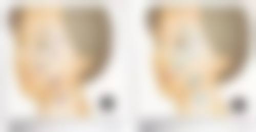 头发稀少毛发种植的主流技术：各有优势选合适