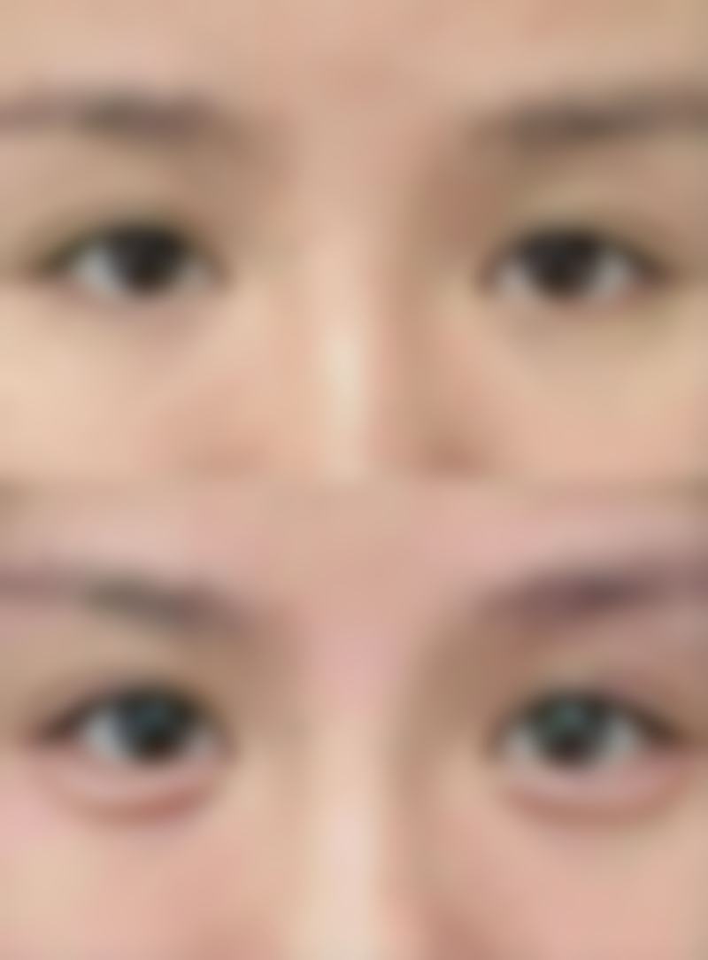 如何巧妙修复痘痘疤痕？辅助产品来帮忙