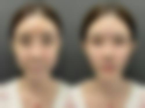 抽脂瘦大腿安全吗？规范操作、合理护理，助你畅享低风险瘦腿塑形体验 