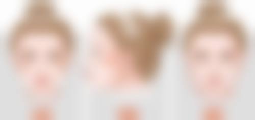 肋软骨隆鼻修复的优势体现