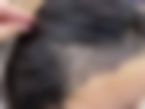 六、温州大麦微针植发怎么预约：