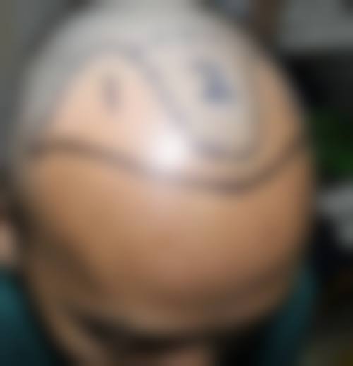 三、温州大麦微针植发医生介绍: