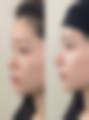 肋软骨隆鼻多久能恢复自然？3 - 6 个月基本定型，多因素影响恢复时长与效果 