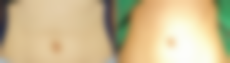 取肋软骨供区修复时间知多少