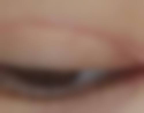 手术治疗疤痕疙瘩，解决顽固问题