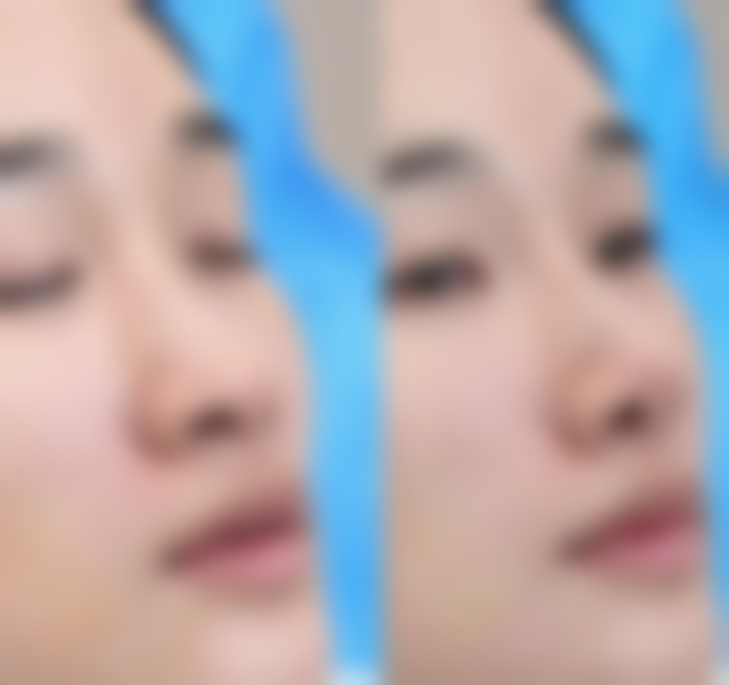 割双眼皮前需留意啥？选正规机构、做好身体检查及术前沟通让手术更安心 