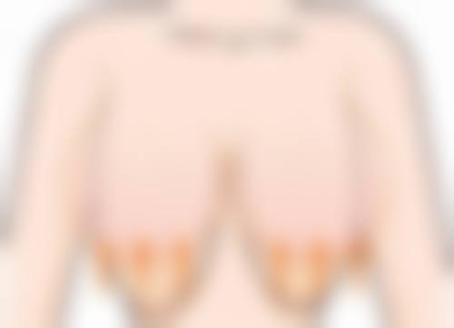 假体隆胸喂奶的优势
