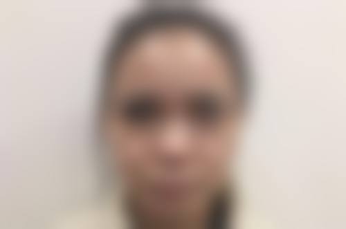 隆胸300假体究竟大不大？适配特定身材与需求，实现罩杯升级和圆润外观 