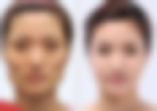 注射玻尿酸隆胸副作用知多少？——血管栓塞危害大