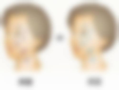 注射玻尿酸隆胸副作用知多少？——局部硬结、包块和纤维化不容忽视
