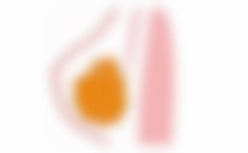 切开双眼皮太宽别烦，做好术后护理与注意事项