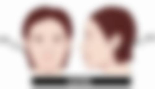 除皱多久见成效？肉毒素3 - 7天、玻尿酸即刻、自体脂肪3个月稳定显优效 
