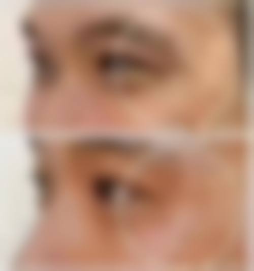 五、新疆维吾尔医医院皮肤美容科实例
