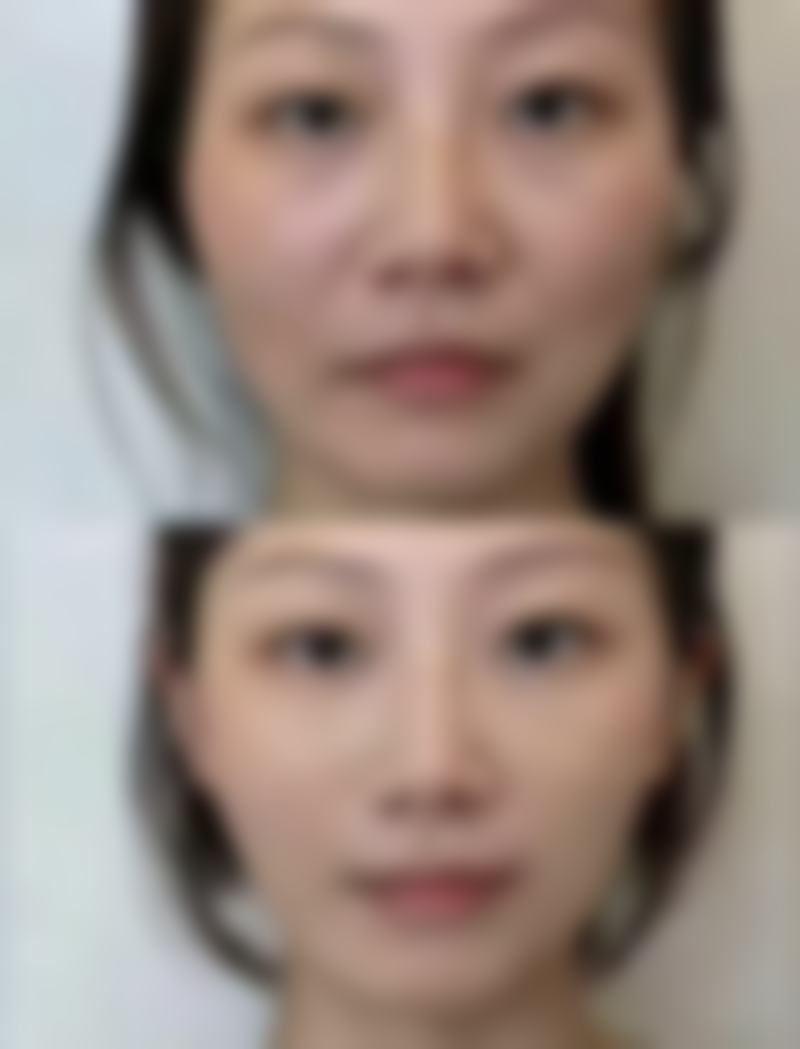 五、福州艾上美整形医院实例