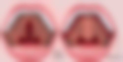 疤痕体质能熬夜吗？揭秘熬夜对疤痕体质皮肤健康及修复的潜在影响 