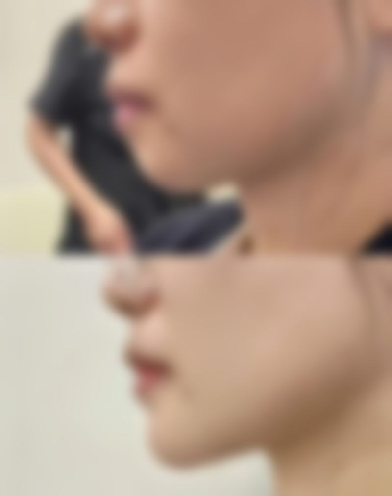 骨膜贴片隆鼻稳定持久吗？看成效与持久性