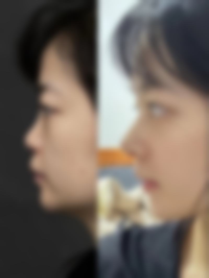 超体隆鼻稳定性强有啥意义?实际作用分析