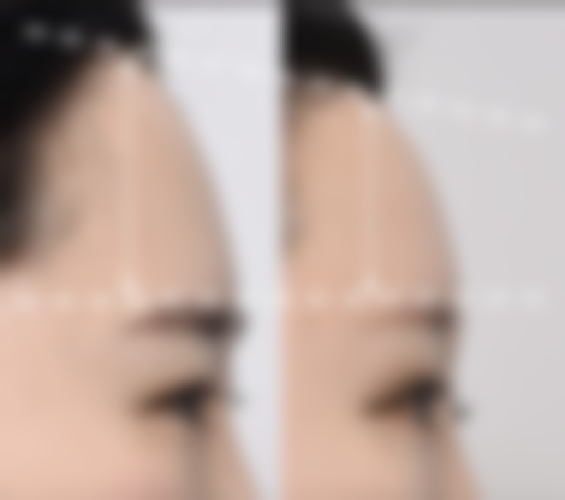 外用药物：直接作用于瘢痕