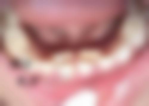 假体隆胸破了是否有感觉？全身症状及检测手段