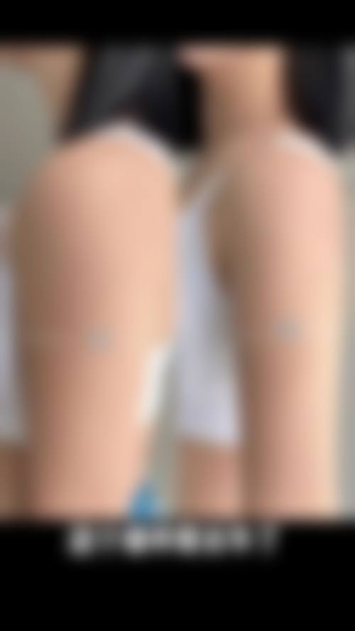 五、杭州昕薇整形美容医院实例