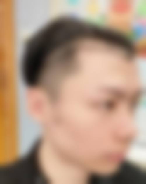 五、西安雍禾植发实例