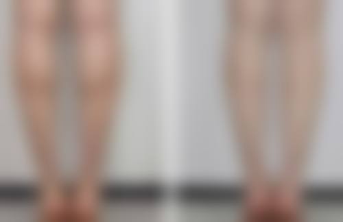 胸口长疤痕疙瘩怎么去除?治疗原则确保方案个性化