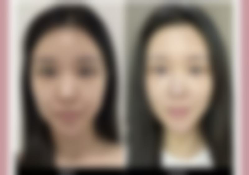 脸上烫伤疤痕变黑能否消退?日常护理要点不能忘