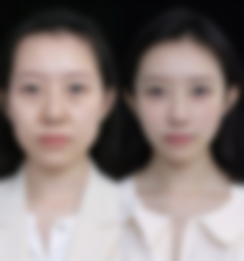 胸口长疤痕疙瘩怎么去除？个性化综合方案+日常护理，双管齐下消除疙瘩烦恼 