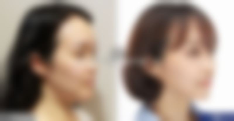 隆鼻成效究竟能维持多久?总结与展望