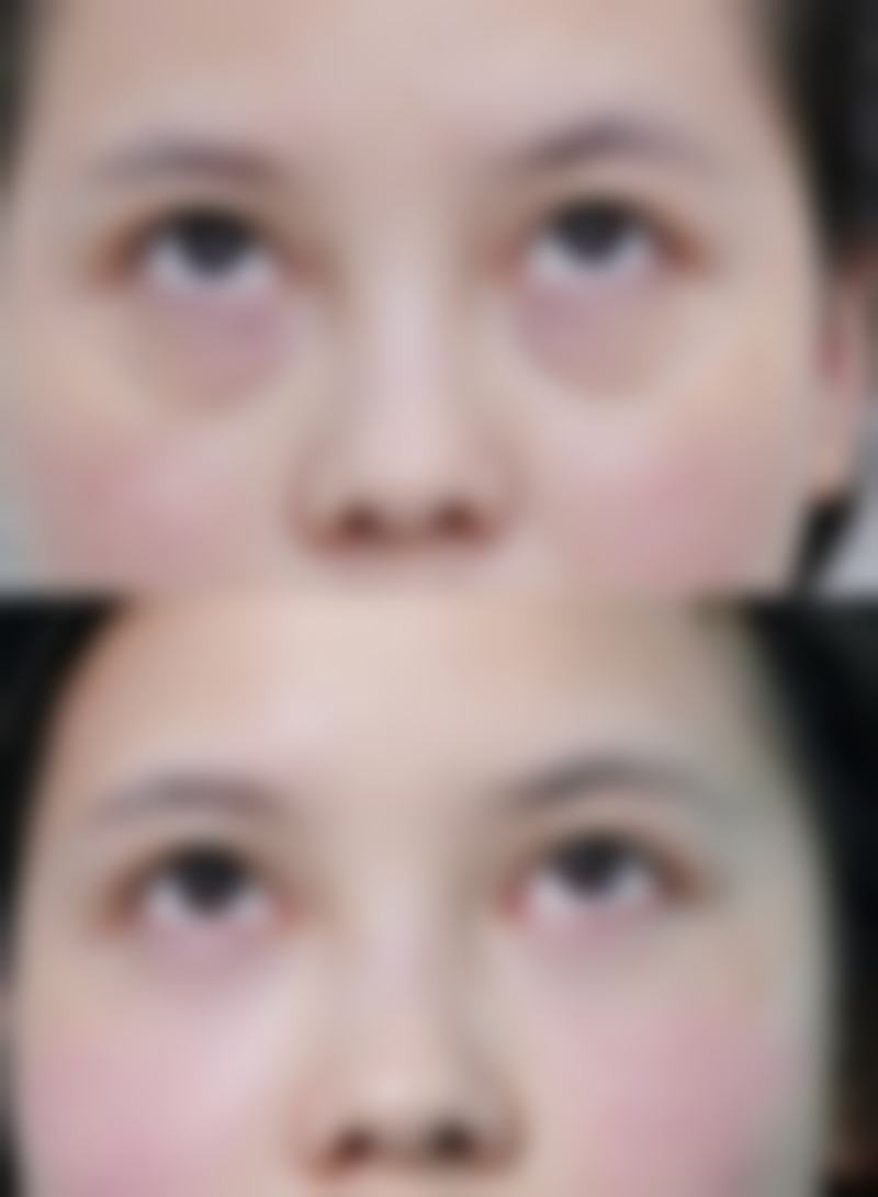 上眼皮厚选手术,术前准备要做好