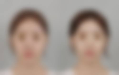 面部疤痕去除有何妙招？多种疗法+日常护理，助你重焕光滑美肌 